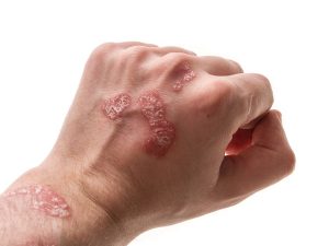 Psoriasis