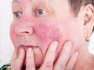 Dermite Séborrhéïque