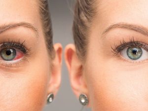 Yeux Secs / Irrités